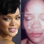 Photo of Rihanna after Domestic Violence by Chris Brown